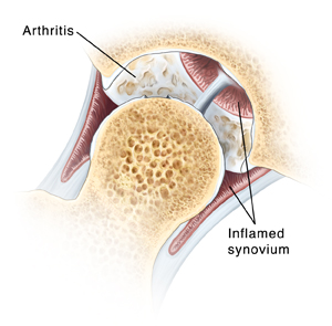 Hip Arthroscopy: Repairing Synovitis and Arthritis