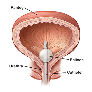 Cross section ng pantog na ipinakikita ang nakalagay na catheter.