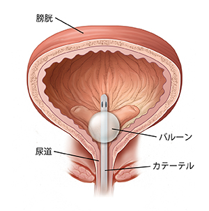 カテーテルが挿入されている膀胱の断面図。