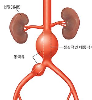 동맥류가 발생한 복부 대동맥류의 전면 모습. 점선 부분이 정상 넓이의 대동맥을 나타냅니다.