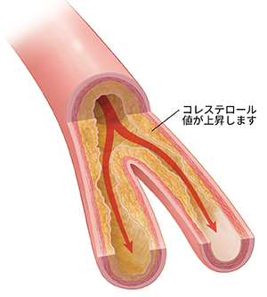 プラークの蓄積と血流の滞りのある動脈の断面。