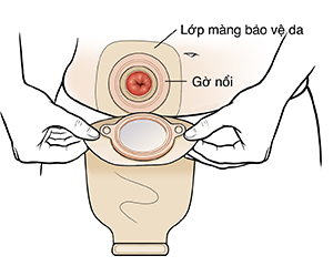 Tay đang đặt túi hậu môn nhân tạo qua lỗ thông đường tiêu.