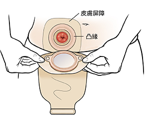 雙手將造口袋置於造口上。