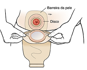 Mãos colocando bolsa de ostomia sobre o estoma.