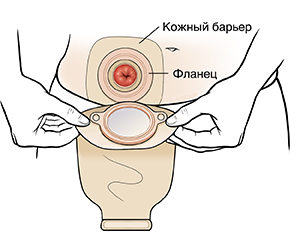 Руки, помещающие остомический мешок над стомой.