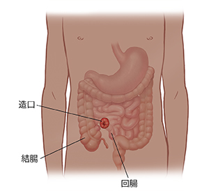 顯示消化道與造口的孩子身體正面視圖。