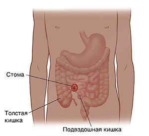 Вид тела ребенка спереди с изображением пищеварительного тракта и стомы.